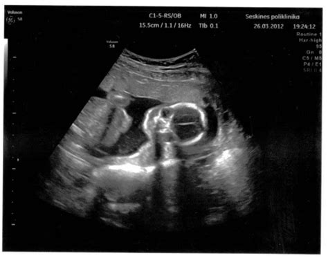 Nėštumo echoskopijos nuotrauka