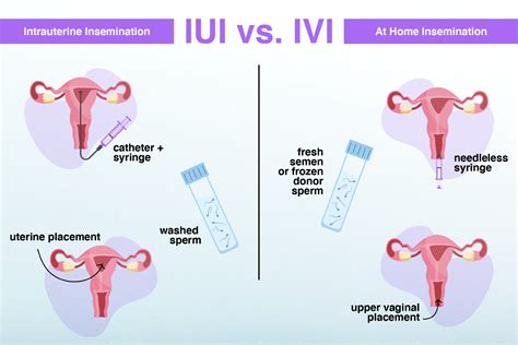 Schema, kaip atliekama intrauterinė inseminacija (IUI)