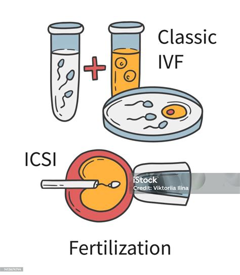 IVF ir ICSI procedūrų palyginimas
