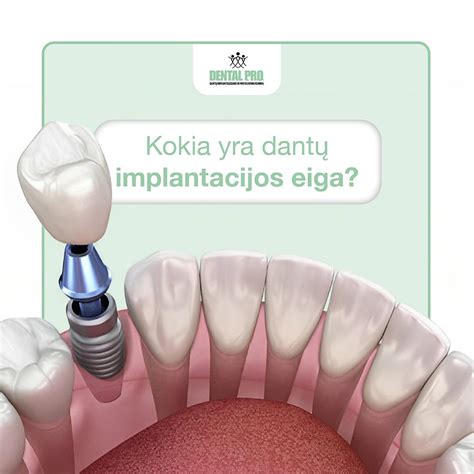 Scheminė implantacijos eiga gimdoje