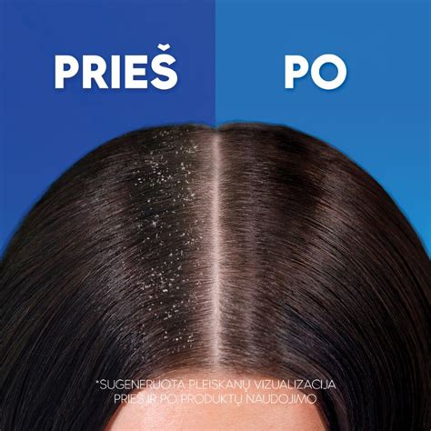 Infografika su patarimais, kaip išvengti pleiskanų.
