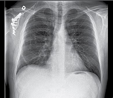 Krūtinės ląstos rentgenograma, kurioje matomi plaučių uždegimo požymiai