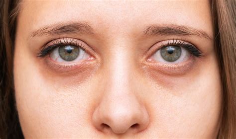 priežastys, dėl kurių atsiranda tamsūs paakiai