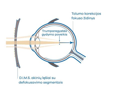 trumparegystės korekcija
