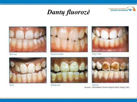 pavyzdžiai kaip atrodo dantų fluorozė