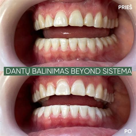 Dantų balinimo procedūra