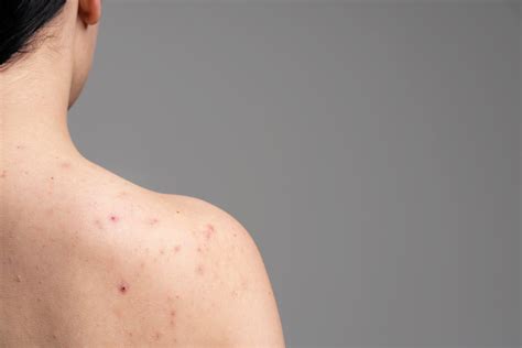 Nuotrauka, iliustruojanti randą ant nugaros po organo pašalinimo