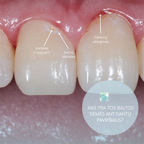 baltos dėmės ant danties