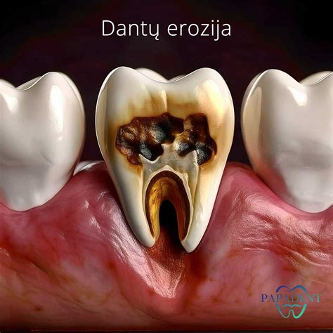 vaiko dantų emalio hipoplazijos simptomai