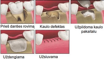 Pieninių dantų šalinimas