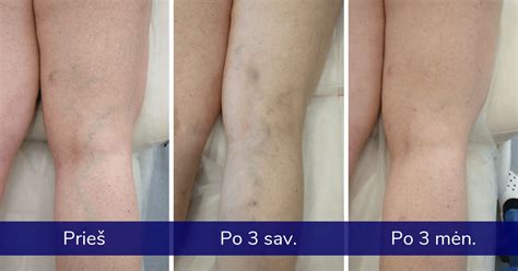 schematinis kojų venų varikozės vaizdavimas