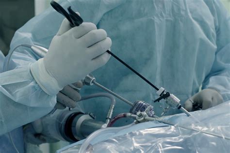 Laparoskopinė kiaušidžių cistos šalinimo operacija