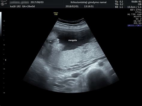 vaisiaus echoskopijos nuotrauka