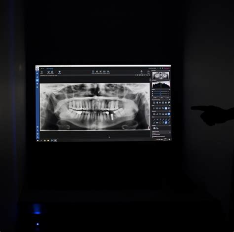 Rentgeno nuotrauka, rodanti dantų implantą ir aplinkinius audinius