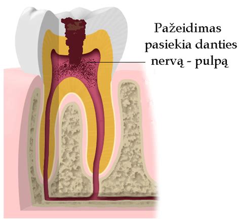 Simptomų, rodančių danties pūlinį, infografika
