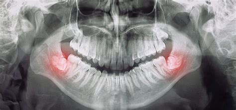 Įvairios naminės priemonės protinių dantų skausmui malšinti