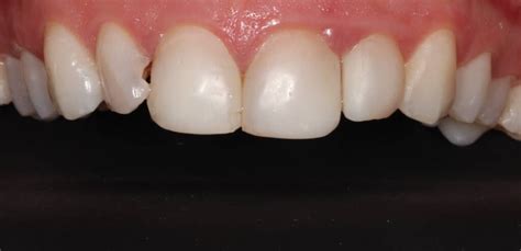 Fluorozės pažeisti dantys