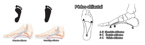 Schema, kaip atrodo šleiva pėda ir sveika pėda
