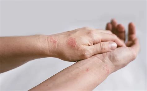 Odos problemų, tokių kaip aknė ir atopinis dermatitas, palyginimas