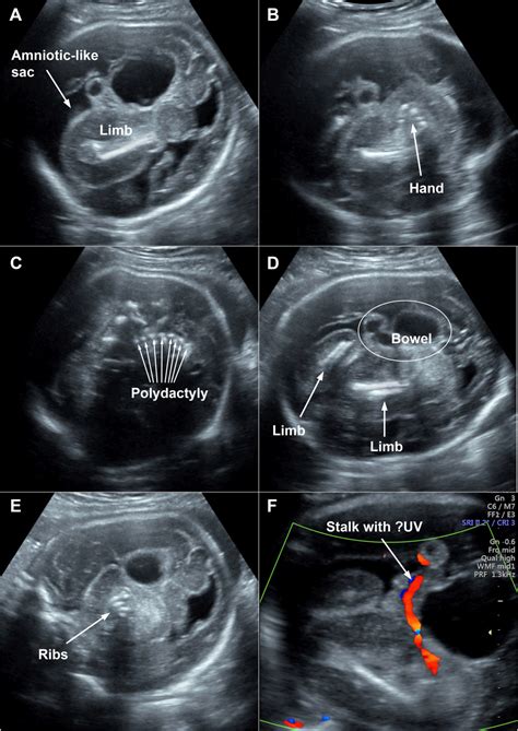 Schematinis vaisiaus vaisiuje (fetus in fetu) pavaizdavimas