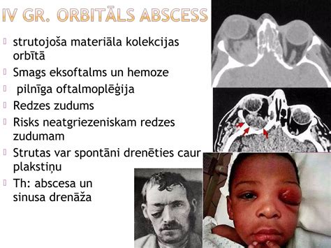Infografika, iliustruojanti galimas placentos pirmeigos komplikacijas