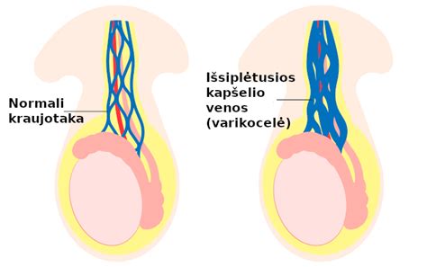 Varikocelės schema