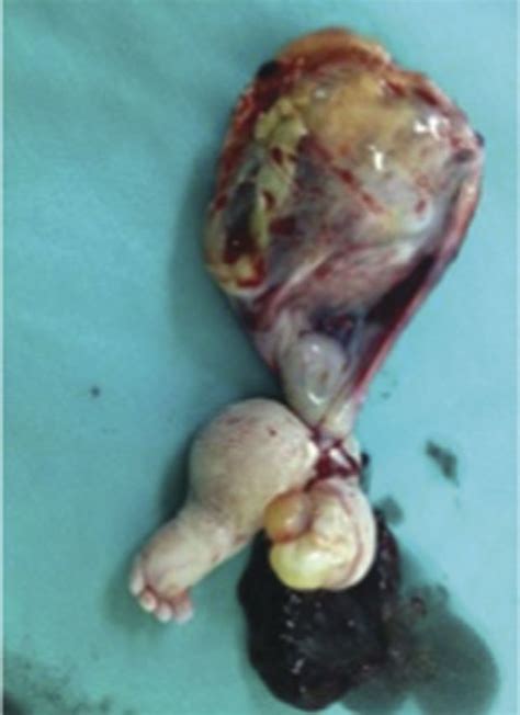 Vaikas su Fetus in fetu sindromu