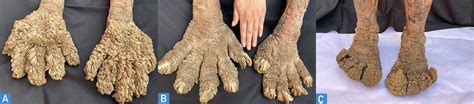Žmogus-medis su Epidermodysplasia verruciformis