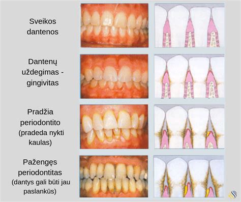 vizualinis skirtumas tarp sveikų dantenų, gingivito ir periodontito