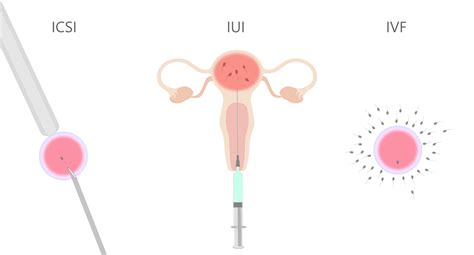 Vizualizacija skirtingų pagalbinio apvaisinimo metodų (IVF, ICSI, IUI)