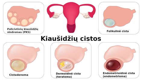 Grafikas, rodantis kiaušidžių cistos pašalinimo operacijos eigą