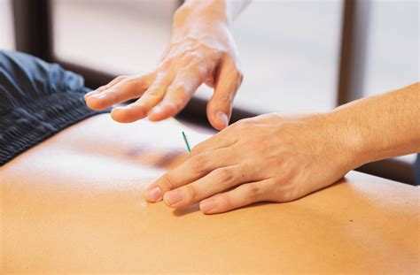 Artinamas vaizdas į akupunktūros adatas