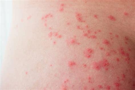 Simbolinis vaizdas, iliustruojantis skirtingas grybelinių infekcijų vietas ant kūno