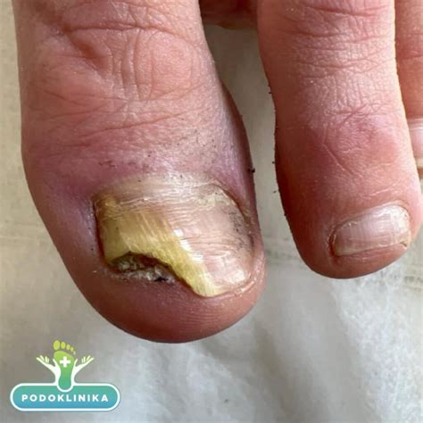 Palyginamoji nuotrauka: sveikas nagas ir nagas, pažeistas grybelio