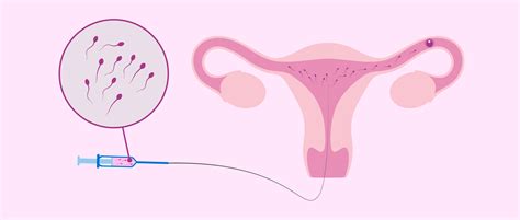 Schema, kaip veikia intrauterininė inseminacija (IUI)