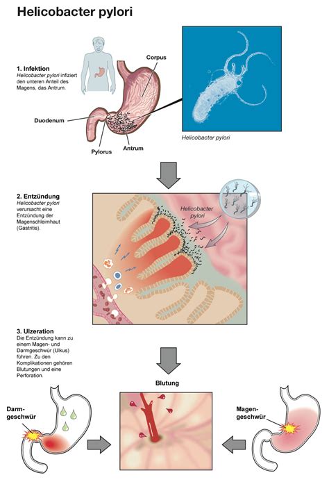 Helicobacter pylori bakterijos mikroskopinis vaizdas