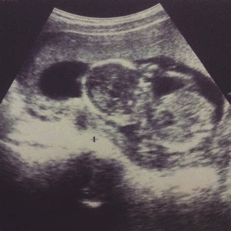 Echoskopijos nuotrauka