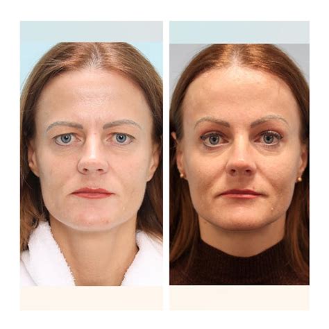 Palyginimas: krūtinės mažinimo operacija prieš ir po