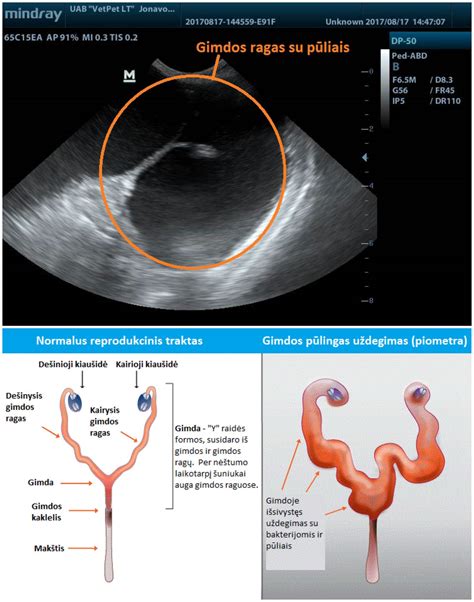 Infografika su gimdos polipų simptomais