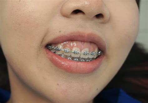 Įvairių tipų breketų palyginimas