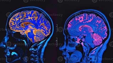 schema of brain changes after childbirth