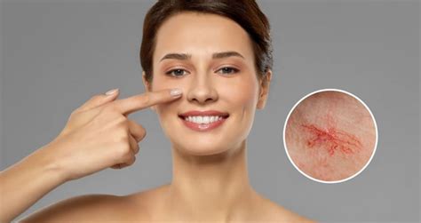 Scheminis vaizdas, kaip atrodo kapiliarų tinklas ant odos