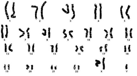 Žmogaus kariotipas su chromosomomis