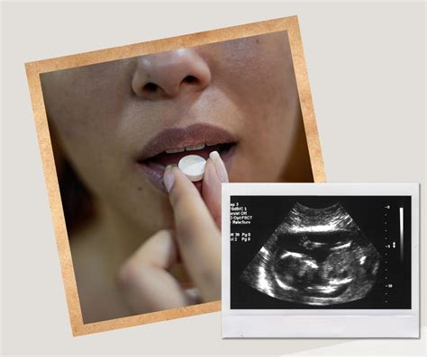 medikamentinio aborto schematinis vaizdas