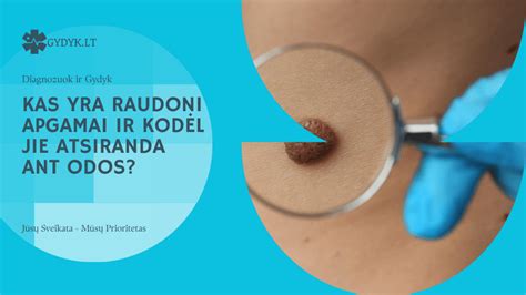 Raštas ant krūties odos, rodantis uždegimą