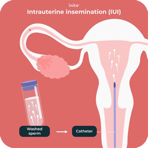 Intrauterininės inseminacijos (IUI) procedūros schema