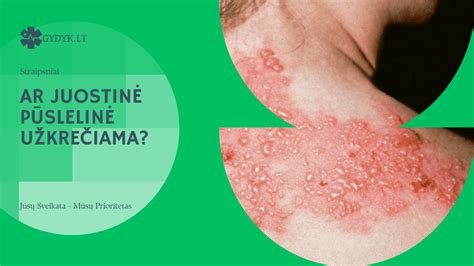 Žieduotosios pūslelinės išvaizda ir gydymas