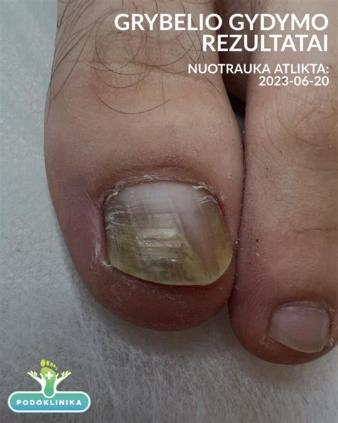 Nagų grybelio simptomai ir gydymo priemonės
