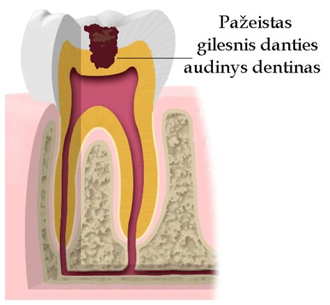 Schema, kaip atsiranda dantų ėduonis