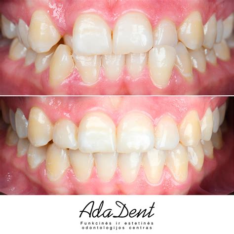 Vizito pas odontologą svarba nėštumo metu